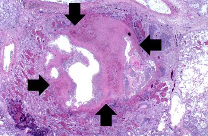 This low-power photomicrograph of lung from this case demonstrates one of the abscesses (arrows). Note that the material inside the abscess has been expelled.