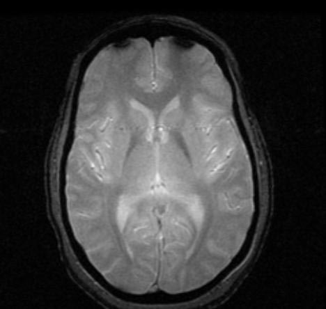 File:Normal-brain-MRI-005.jpg
