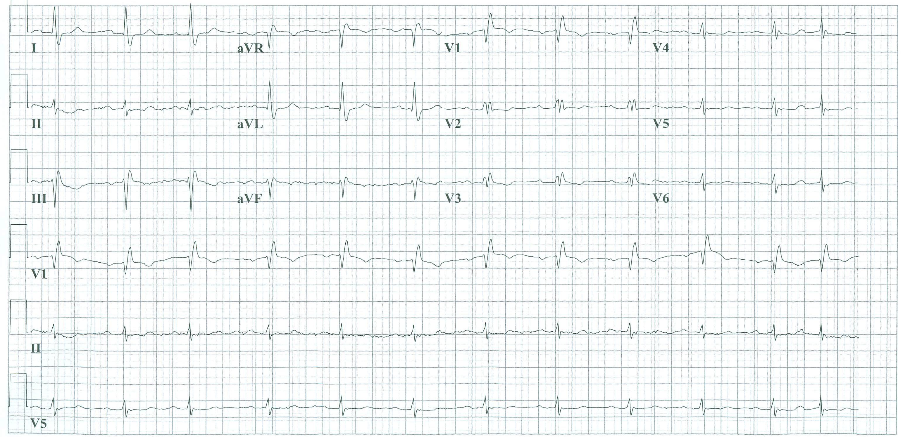 The same patient before acute MI developed. Horizontal axis shown.