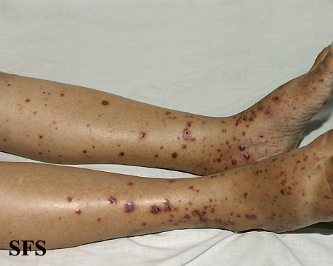 File:Allergicvasculitis09.jpg