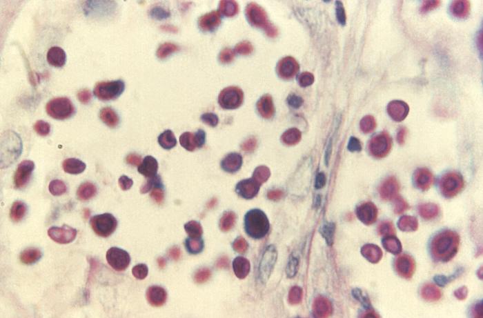 Periodic acid-Schiff-stained photomicrograph revealed some of the histopathologic details associated with a disseminated Cryptococcus sp. infection involving the liver (980x mag). From Public Health Image Library (PHIL). [7]