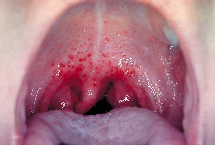 Inflammation of the oropharynx and petechiae, or small red spots on the soft palate caused by Strep Throat. From Public Health Image Library (PHIL). [1]
