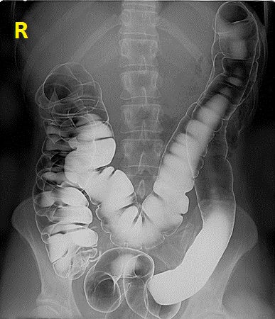 File:Human intestinal tract, as imaged via double-contrast barium enema.jpg