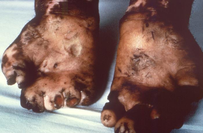 Hands of leprosy patient. Note severe mutilation, and degeneration of all fingers. Adapted from Public Health Image Library (PHIL), Centers for Disease Control and Prevention.[5]