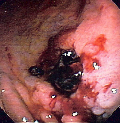 Gastric ulcer in antrum of stomach with overlying clot. Pathology was consistent with gastric lymphoma. Reproduced with permission of patient]]