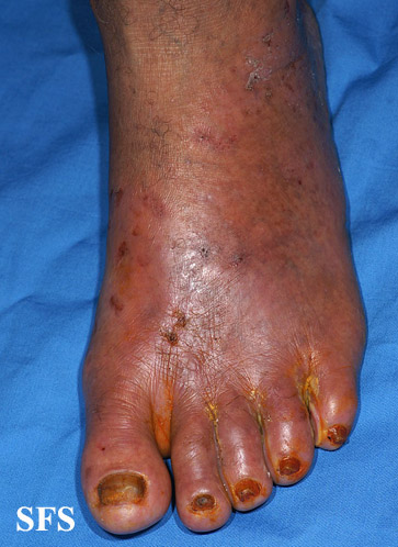 Peripheral arterial disease physical examination - wikidoc