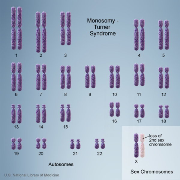 File:Monosomy.jpeg