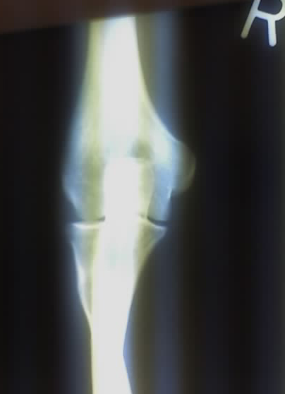 Close-up radiograph, right elbow-joint