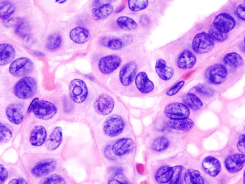 Micrograph (high power view) showing nuclear changes in papillary thyroid carcinoma (PTC), which include groove formation, optical clearing, eosinophilic inclusions and overlapping of nuclei. H&E stain.[15]