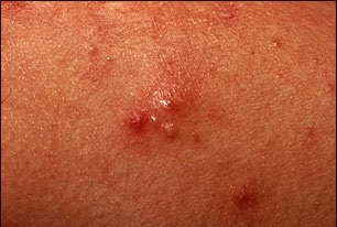 Acne lesions frequently contain pus. This close-up photograph shows small acne pustules with surrounding inflammation (erythema).