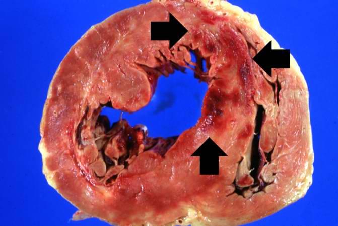 A gross image of the heart from this case, note the area of fresh myocardial infarction (arrows) in the anterior portion of the left ventricle and extending into the anterior portion of the interventricular septum. Note that the walls of the left and right ventricle are slightly thicker than normal.