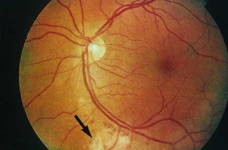CMV Retinitis Image obtained from U.S. Department of Veterans Affairs - Image Library [3] (Paul A. Volberding, MD, University of California San Francisco)