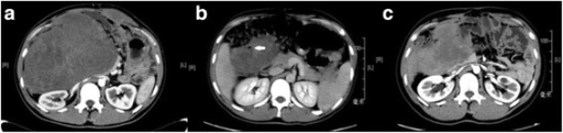File:Desmoid intestine perforation.png