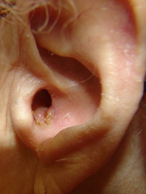Boil (furuncle) occluding the right external auditory meatus.[1]