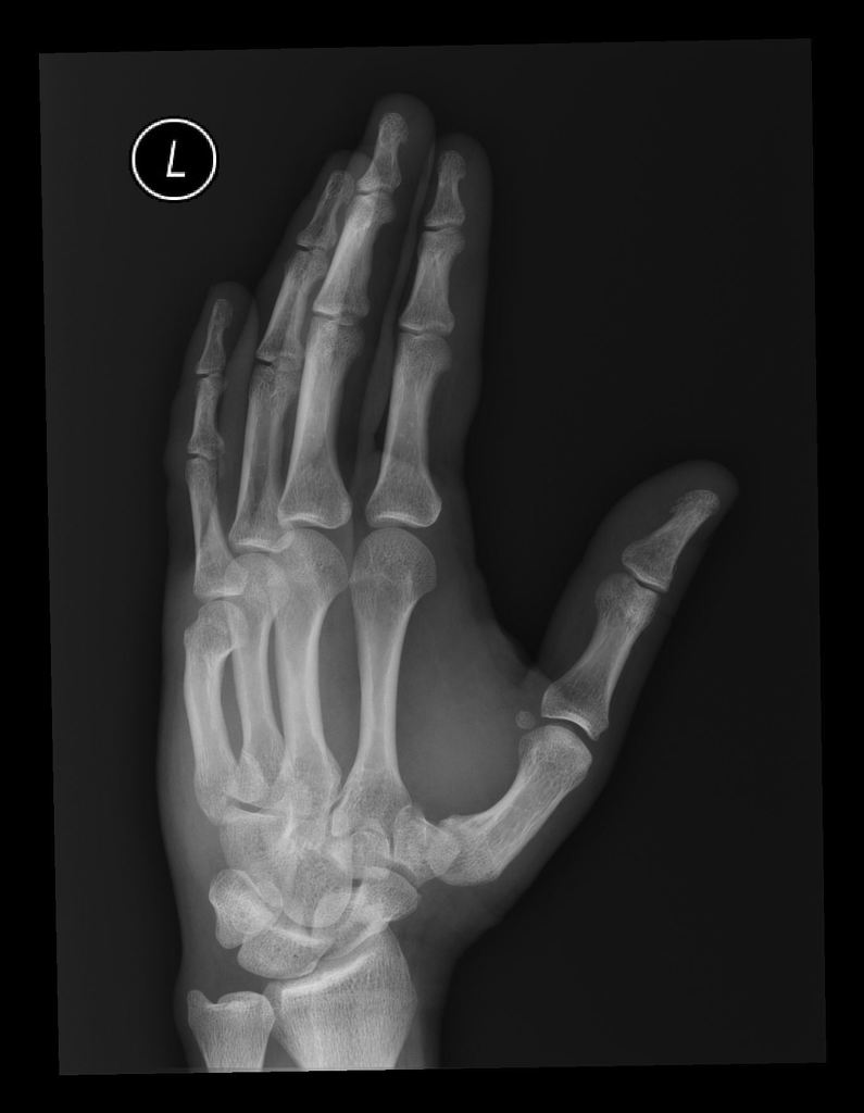 Oblique fracture of the base of the 5th metacarpal bone with 2mm radial displacement of the fractured fragment and proximal displacement of the metacarpal bone by 3mm. The 5th CMC joint is also involved and results in a 3mm step. Soft tissue swelling adjacent to the fracture site is also noted.