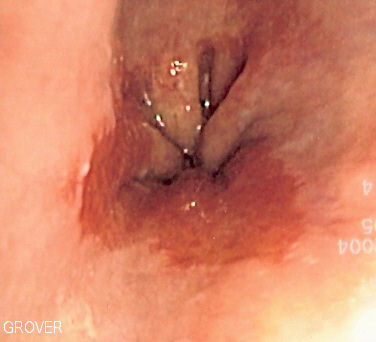 Barrett's esophagus is considered to be a risk factor for esophageal adenocarcinoma
