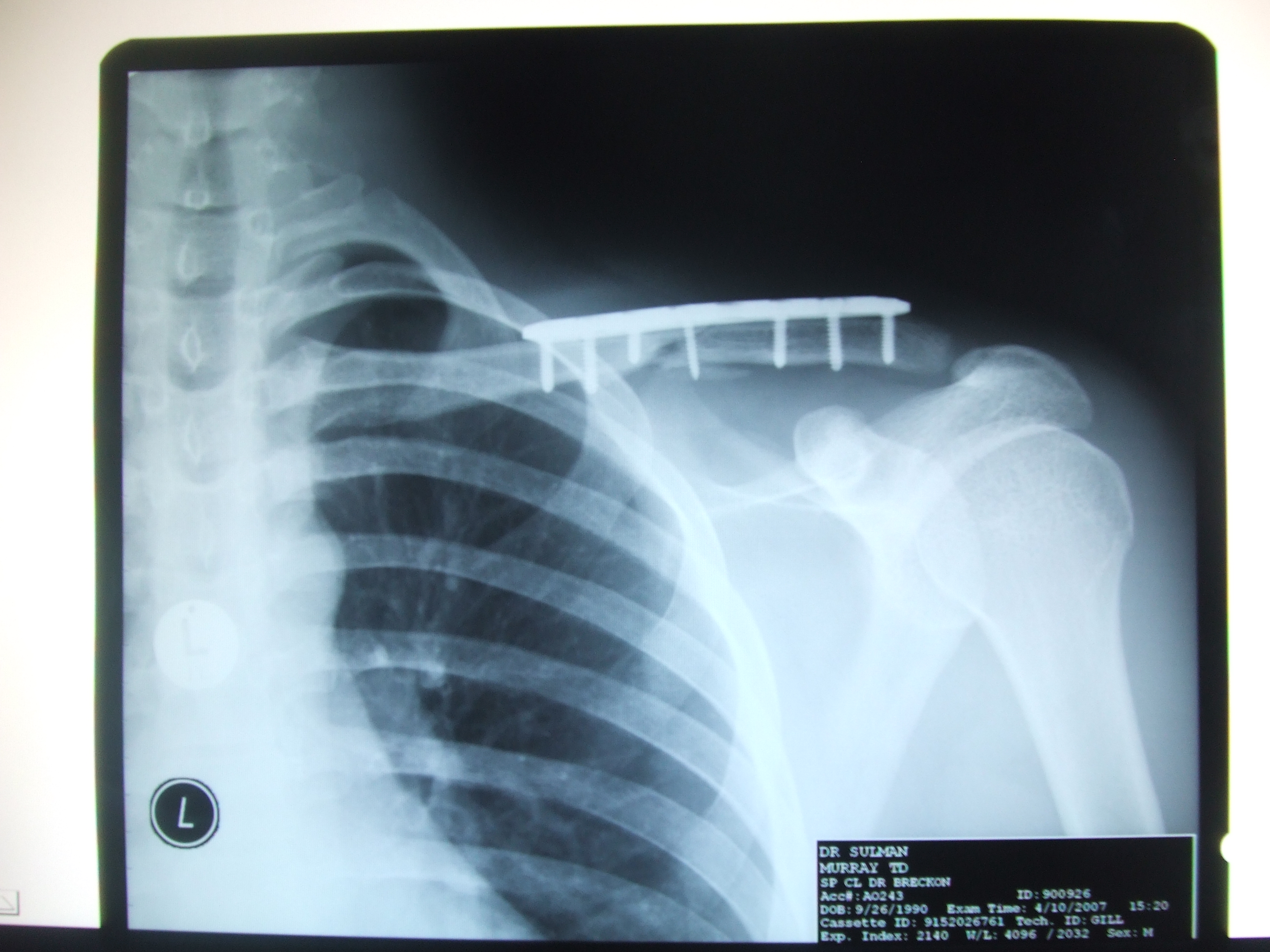 Clavicle fracture - wikidoc