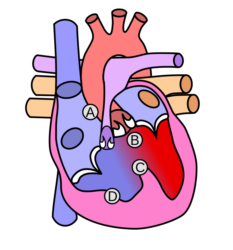 File:Heart tetralogy fallot.svg.png