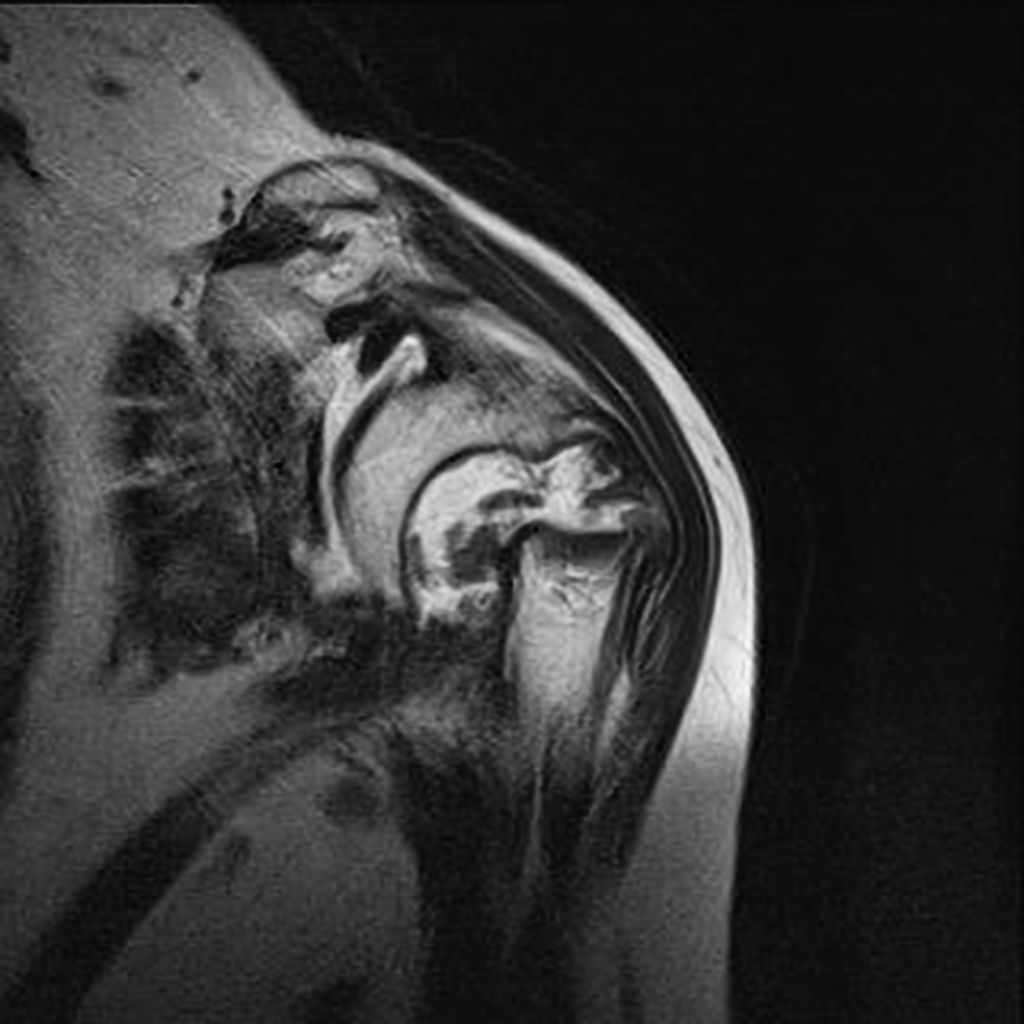 Coronal T2- Complete fracture of the anatomical neck of the humeral head with displaced bone fragments, and rotation and bone resorption. Presence of fluid between the bone fragments, with joint effusion and significant synovial thickening (synovitis).