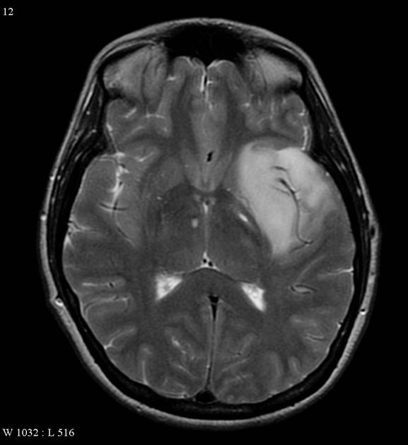 A relatively well circumscribed mass involving the temporal lobe and insular cortex, without convincing enhancement, and minimal restricted diffusion.<ref name=MRI radio>Image courtesy of Dr Frank Gaillard. Radiopaedia (original file here). Creative Commons BY-SA-NC