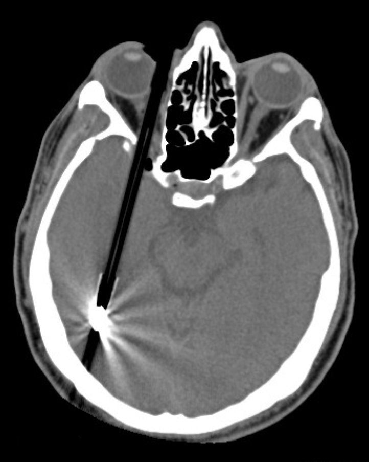 This patient presented with a self-harm injury. The axial CT scan shows a ball-point pen in-situ. The pen missed optic nerve, middle cerebral artery and any eloquent brain. A cerebral angiogram was performed which was normal except for truncation of the ophthalmic artery. The pen was removed under flouroscopic guidance. Upon removal, there was brisk bleeding from the ophthalmic artery. Endovascular embolisation of the bleeding vessel was performed with coils, with good result. The patient’s pupil remains reactive, suggesting a good prognosis for the optic nerve and the patient’s vision. (Image courtesy of Dr Laughlin Dawes)