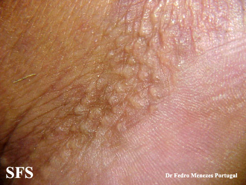 Acrokeratoelastoidosis. Adapted from Dermatology Atlas.[5]