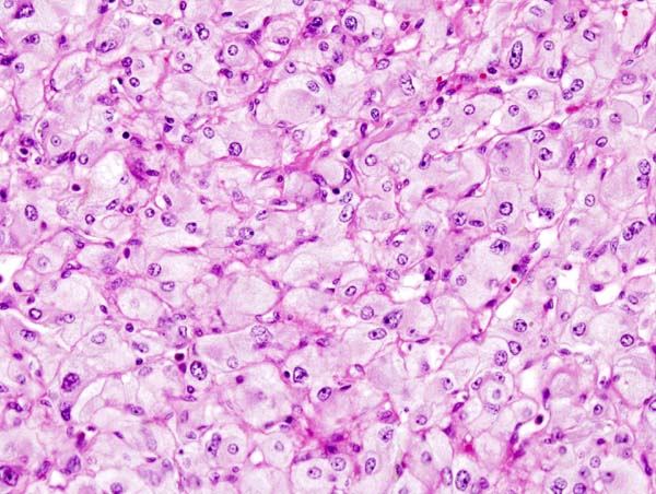 Micrograph of pheochromocytoma. Source: CC BY-SA 3.0, https://commons.wikimedia.org/w/index.php?curid=535944