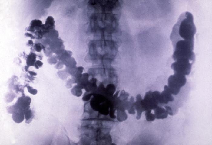 Amebiasis seen in radiograph. Adapted from Public Health Image Library (PHIL). [1]