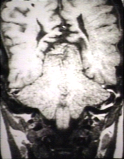 Brain: Arnold Chiari II, with Towering of The Cerebellum and Wide Tentorial Incisure; T1 (MRI)
