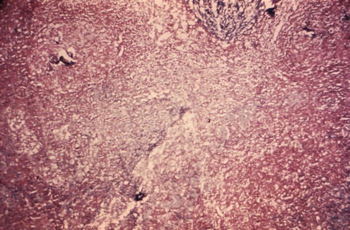 Ultrastructural histopathology in a tissue specimen from a patient with a keloidean blastomycosis infection, which was caused by the fungus, Blastomyces dermatitidis. From Public Health Image Library (PHIL). [26]