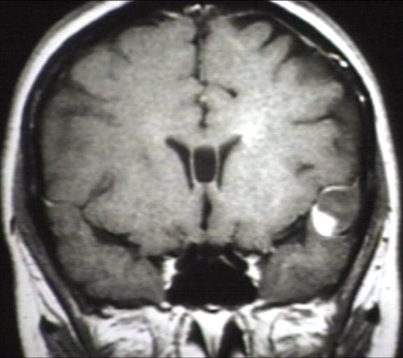 MRI of ganglioglioma