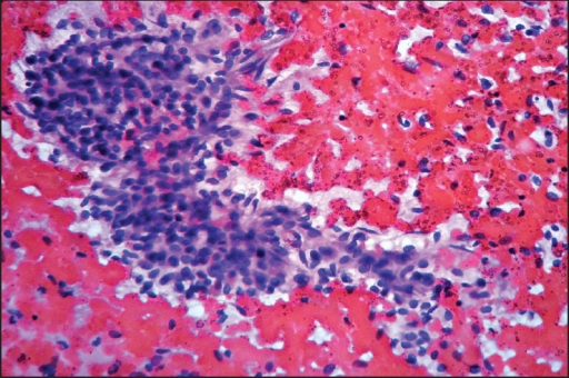 File:Luteinised thecomas with sclerosing peritonitis.png
