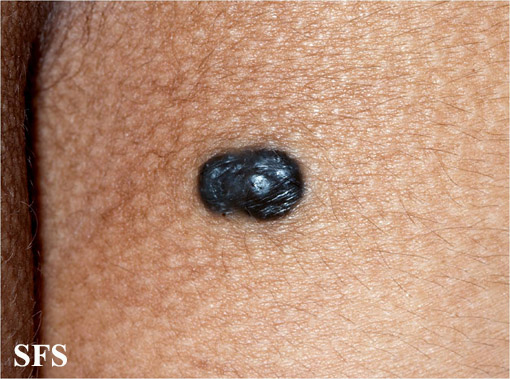 Blue nevus syndrome - wide 1