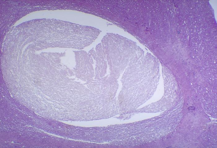 A photomicrograph of the thoracic spinal cord depicting degenerative changes due to Polio Type III.Adapted from Public Health Image Library (PHIL), Centers for Disease Control and Prevention.[8]