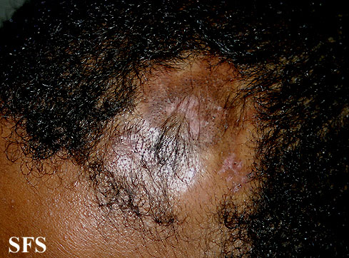 Syringolymphoid hyperplasia with alopecia. Adapted from Dermatology Atlas.[5]