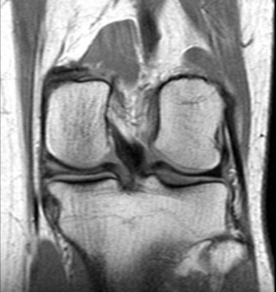 File:Tear-posterior-horn-medial-meniscus-004.jpg