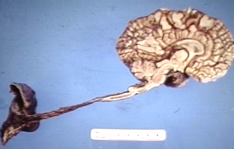 Brain: Arnold Chiari Malformation