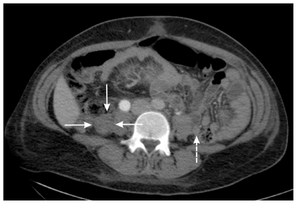 Normal left ovarian vein (dashed arrow) and right, enlarged and thrombi-filled, ovarian vein (three solid arrows)