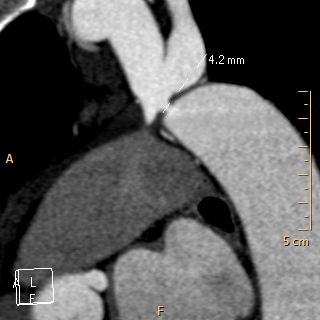 File:Coarctation-of-the-aorta-CT-002.jpg