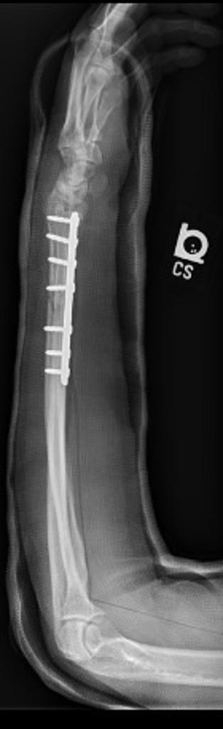 PA- Type 1 Galeazzi fracture