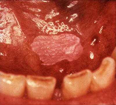 Homogenous leukoplakia in the floor of the mouth in a smoker. Biopsy showed hyperkeratosis.