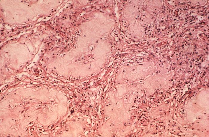 Case of lepromatous or multibacillary leprosy, with photomicrograph revealing histopathologic changes in human testicular tissue, including a large number of “foam cells”.Adapted from Public Health Image Library (PHIL), Centers for Disease Control and PreventionPublic Health Image Library (PHIL), Centers for Disease Control and Prevention[5]