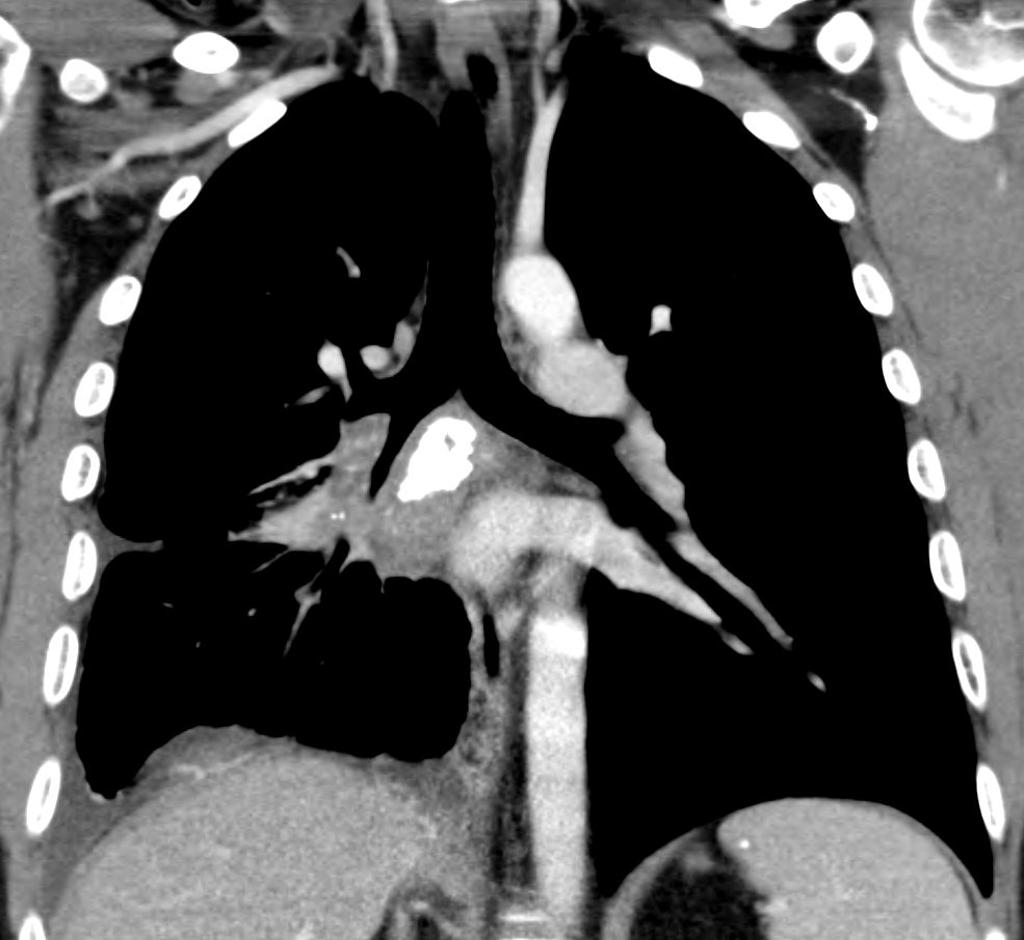 Coronal CT demonstrating airway narrowing of the right lower lobe bronchus. There is thickening of the right pleura and right interlobular septae. There are partially calcified right hilar and mediastinal lymph nodes.[4]