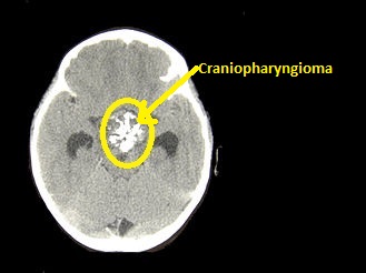 Case courtesy of- Matthew R Garnett, Stéphanie Puget, Jacques Grill, Christian Sainte-Rose. Craniopharyngioma. Orphanet Journal of Rare Diseases. 2, 18. 2007. doi:10.1186/1750-1172-2-18. PMID 17425791, CC BY 2.0, https://commons.wikimedia.org/w/index.php?curid=2524556