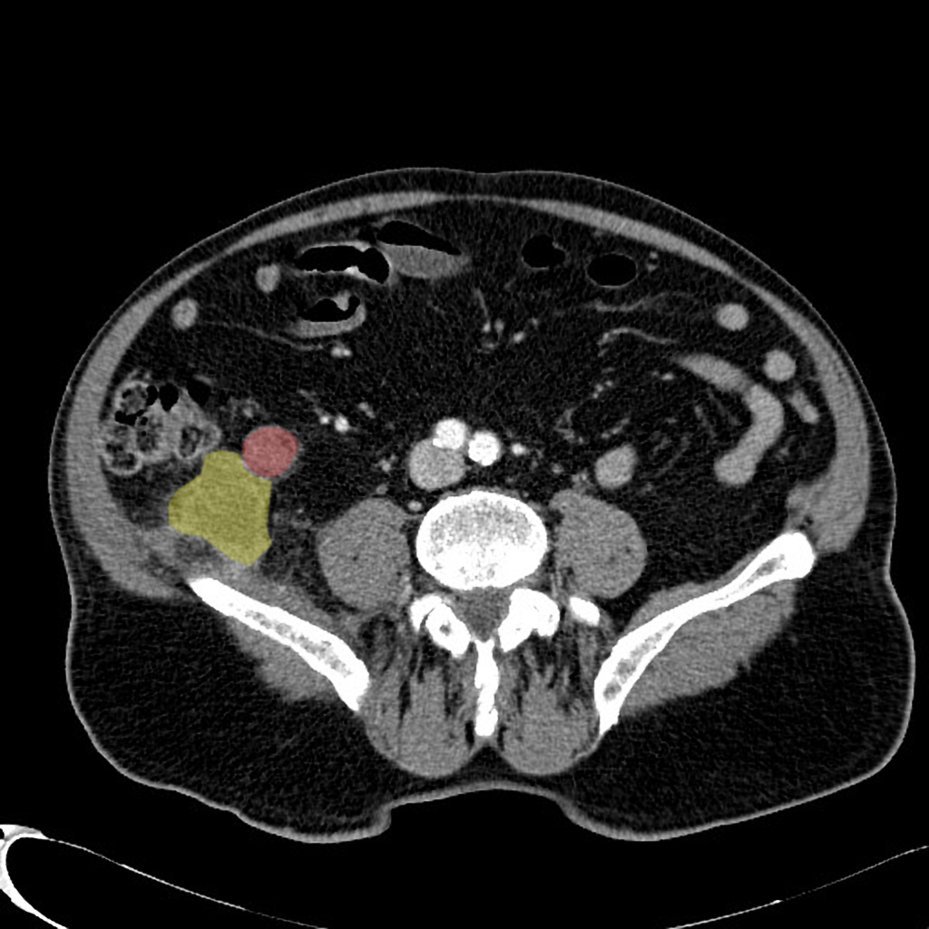 File:Appendiceal-adenocarcinoma-complicated-by-retroperitoneal-abscess (1).jpg