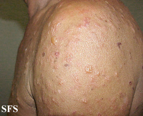Bullous pemphigoid. With permission from Dermatology Atlas.[1]