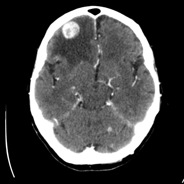 Contrast CT scan of a 80 year old hispanic female with known history of lung cancer, presenting with impaired consciousness, demonstrates an enhanced mass in the right frontal hemisphere.[10]