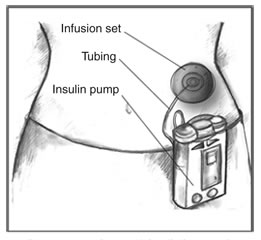 File:Insulin Pump.jpg