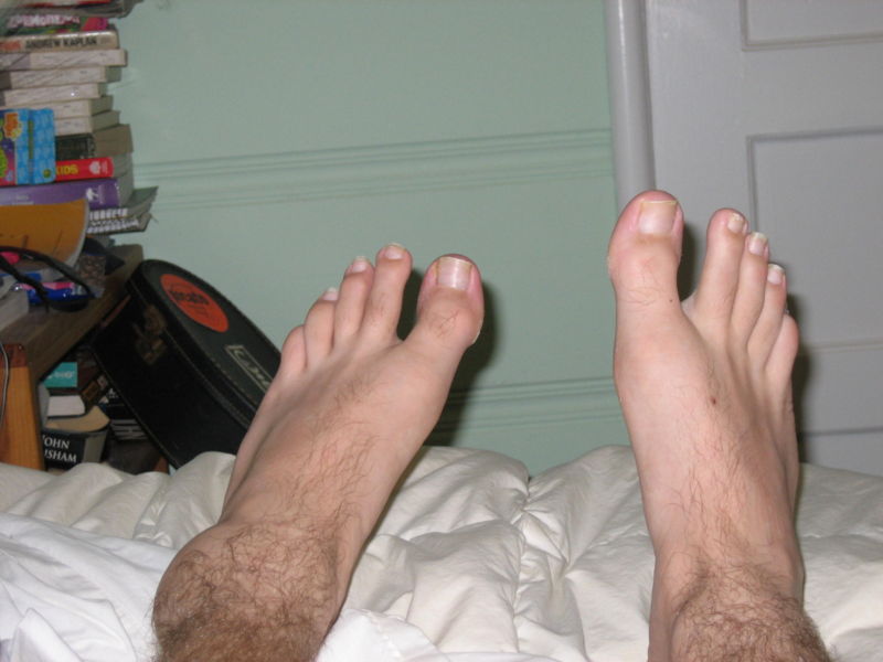 Swollen ankle.jpg