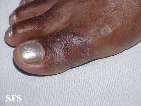 File:Tuberculoid leprosy44.jpg